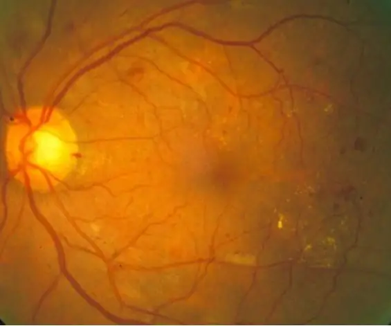 Diagnòstic automatitzat de retinopatia diabètica mitjançant MATLAB: 33 passos