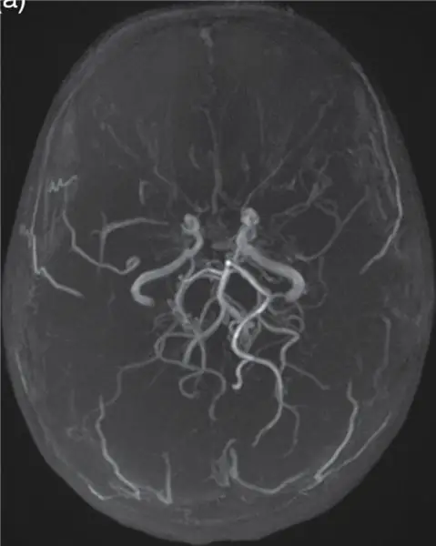 Encuentre resonancias magnéticas y resonancias magnéticas de un cerebro normal y un cerebro afectado por Moyamoya