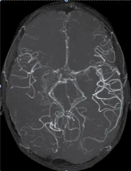 Encuentre resonancias magnéticas y resonancias magnéticas de un cerebro normal y un cerebro afectado por Moyamoya