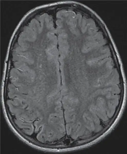 Encuentre resonancias magnéticas y resonancias magnéticas de un cerebro normal y un cerebro afectado por Moyamoya