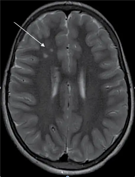 Encuentre resonancias magnéticas y resonancias magnéticas de un cerebro normal y un cerebro afectado por Moyamoya