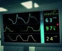 Qarku i Mbledhjes së EKG: 5 hapa