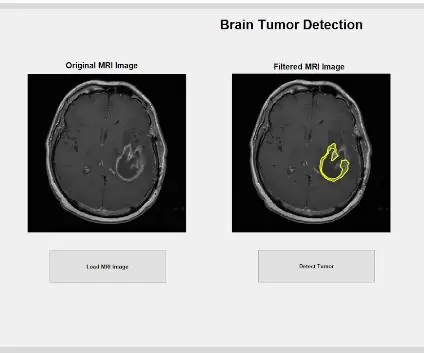 Detección por resonancia magnética de tumores cerebrales con Matlab: 6 pasos