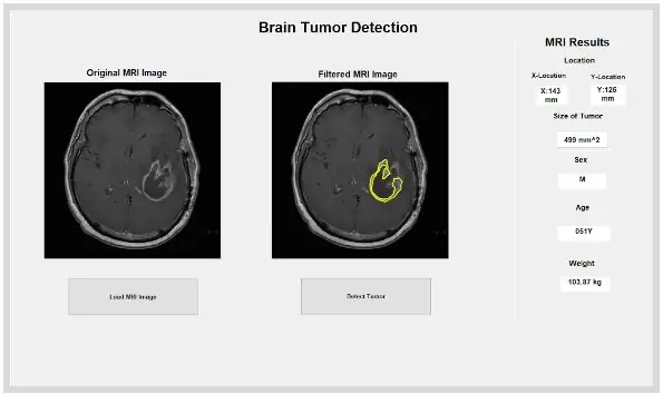 Smadzeņu audzēja MRI noteikšana, izmantojot Matlab