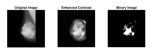 Ús de llindars d’intensitat d’escala de grisos variables per visualitzar i identificar anomalies en imatges de mamografia